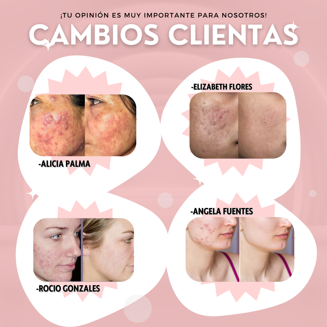 Dermabelle™: Parches Para Acné